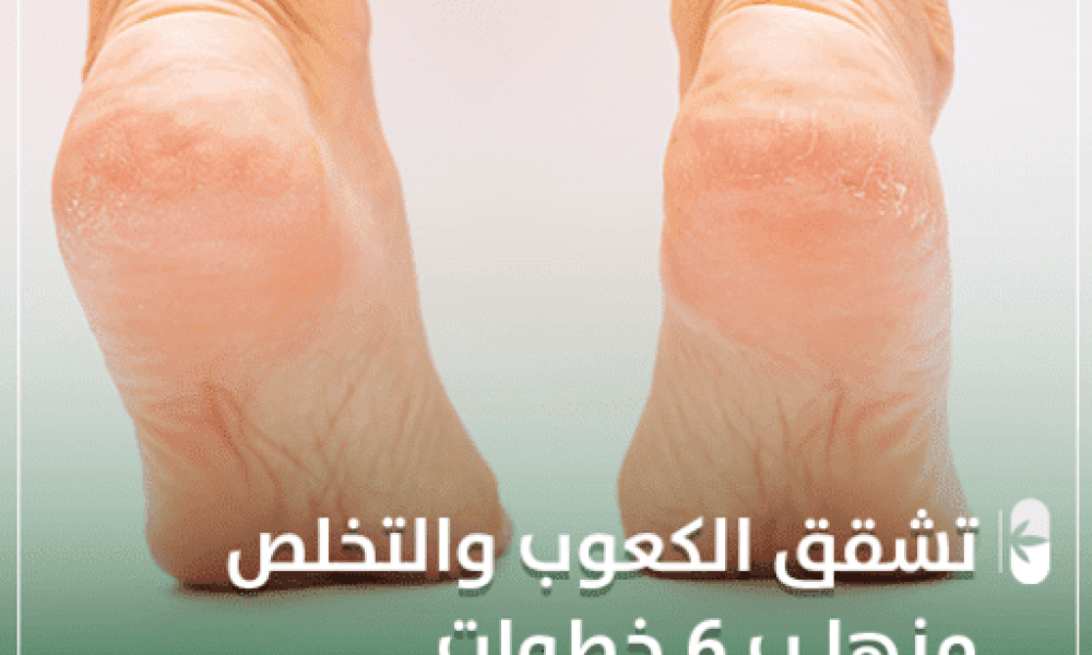 تشقق الكعبين والتخلص منها ب 6 خطوات