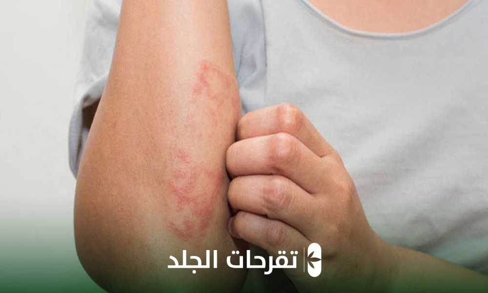 تقرحات الجلد 