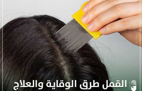 القمل _طرق الوقاية والعلاج