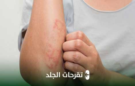 تقرحات الجلد، أسبابها و علاجها